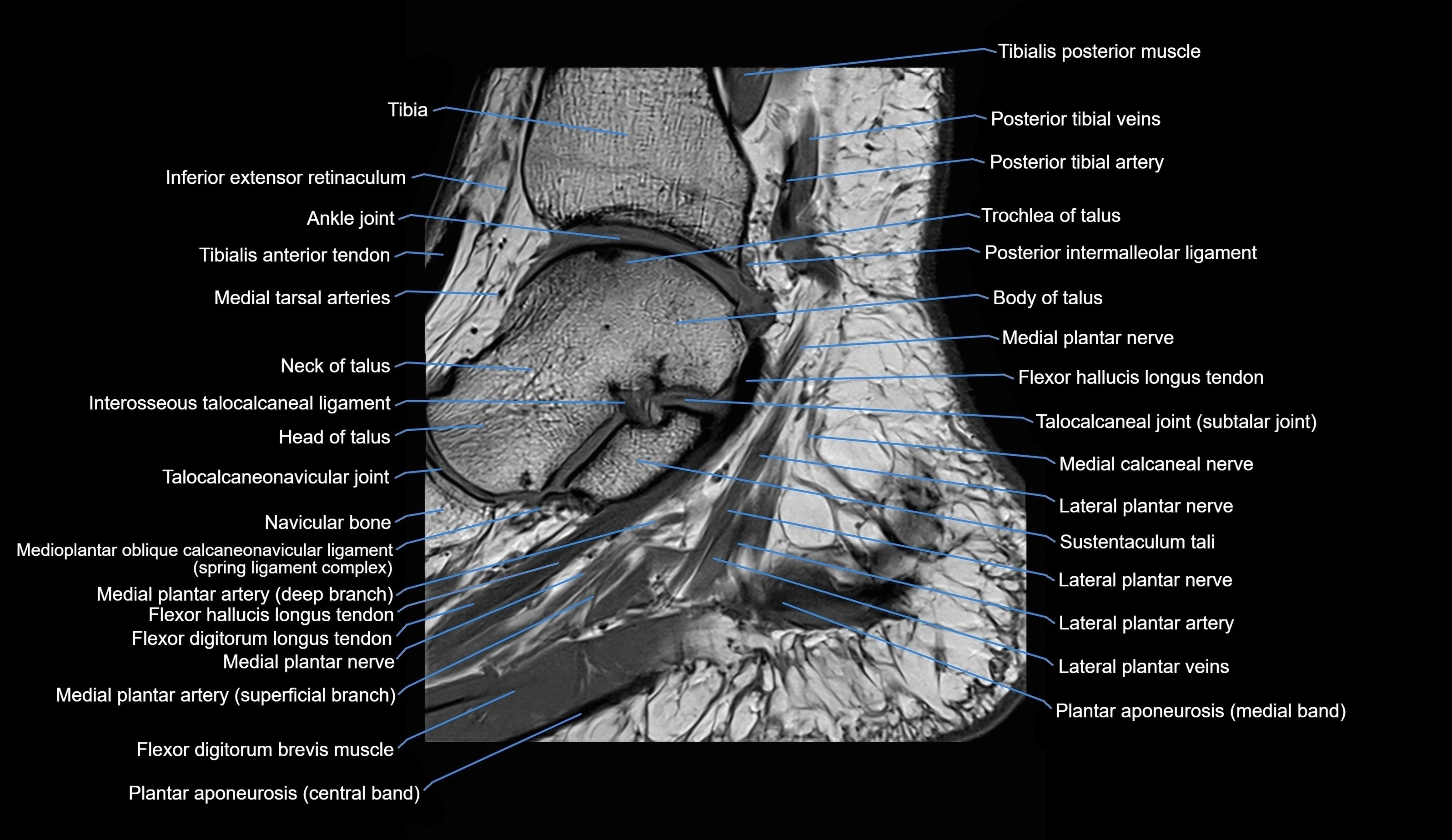 MRI Ankle sagittal cross sectional anatomy 3T  radiology  image-img-00001-00012.webp